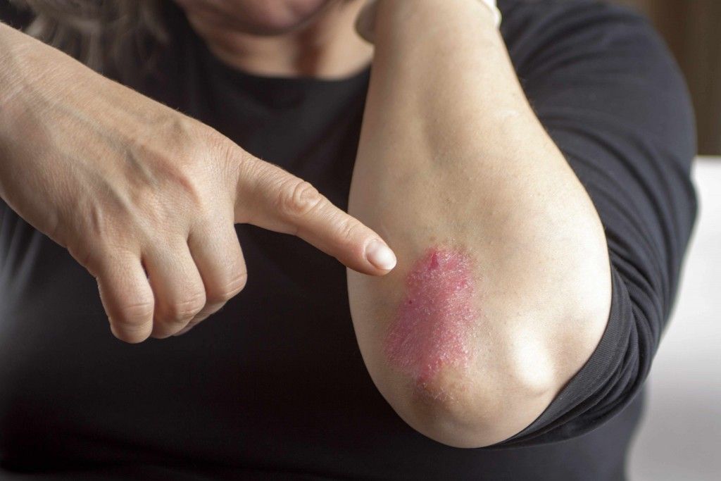 Psoriaz Müalicəsi: Effektiv Kremlər, Dərmanlar və Fototerapiya