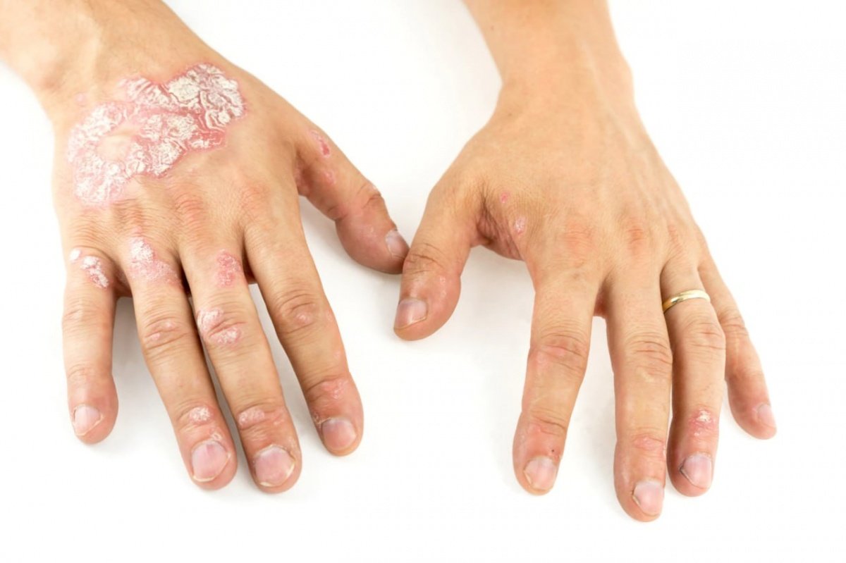 Psoriaz Simptomları və Dəri Üzərində Əlamətləri Nələrdir?