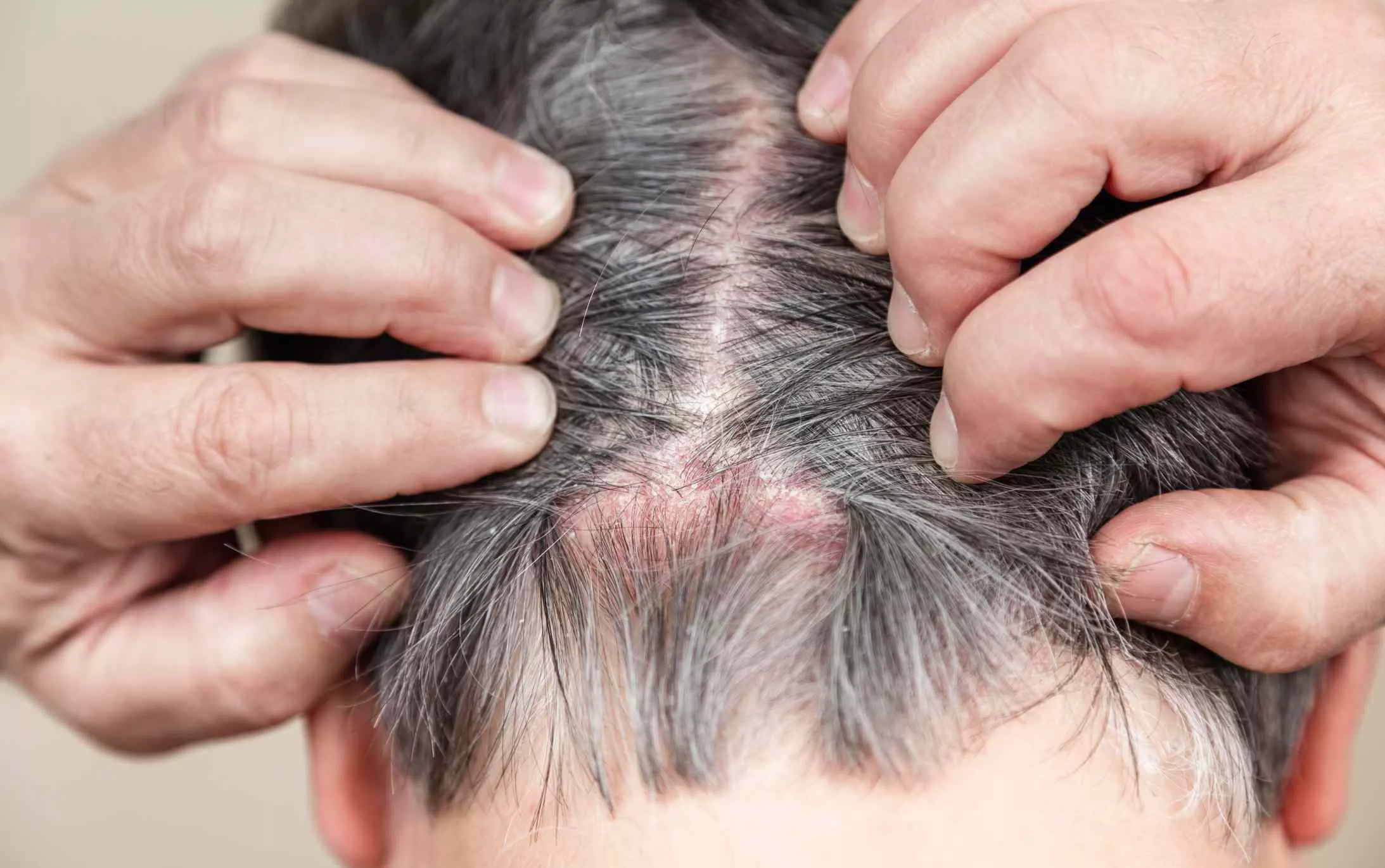 Seboreya Dermatit Nədir? Səbəbləri, Simptomları və Müalicəsi