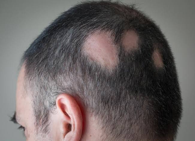 Alopesiya areata nədir? Əlamətləri, səbəbləri və müalicəsi