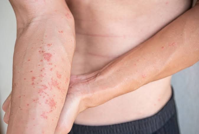 Atopik dermatit (ekzema) nədir və nəyə səbəb olur?