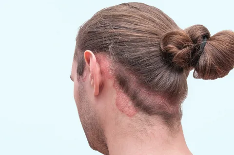 Psoriazlı baş dərisi üçün dərmanlı şampun və təbii həllər