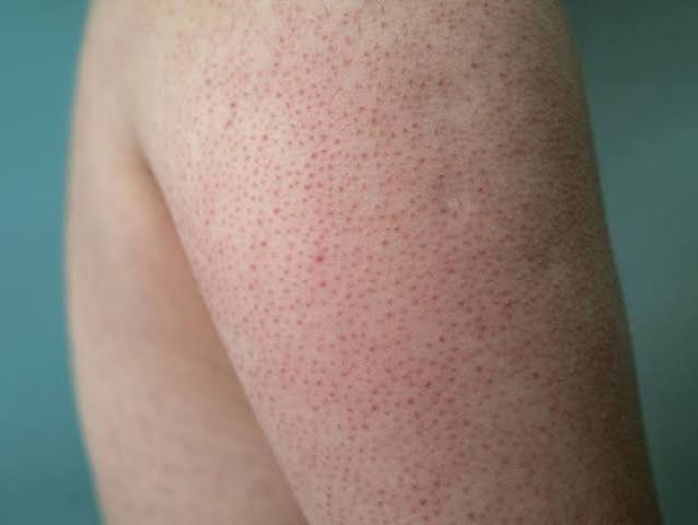 Keratoz pilaris nədir?