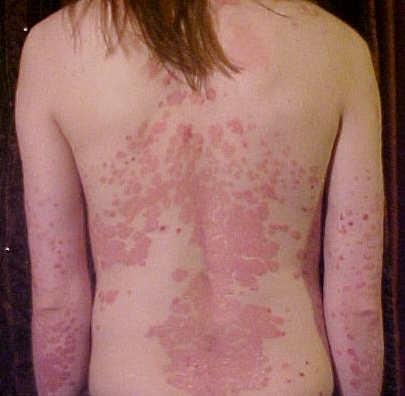 Psoriazın Müalicəsi: Effektiv Müalicə Üsulları və Dərmanlar