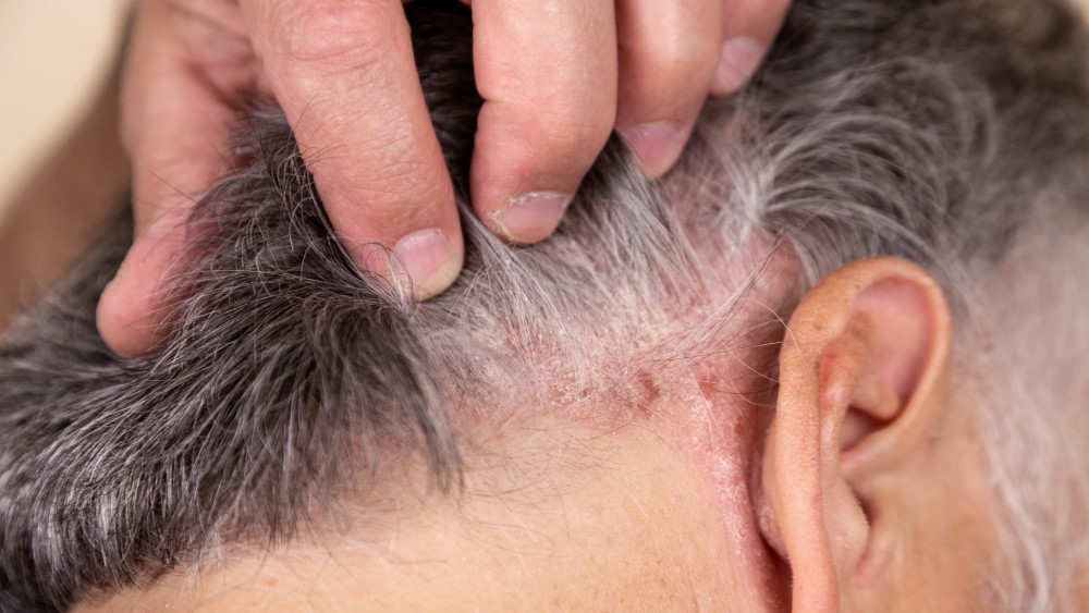 Baş dərisi psoriazını müalicə etməyin ən yaxşı yolu nədir?