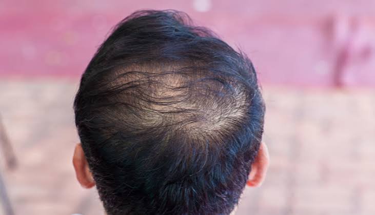 Telogen effluvium nədir?